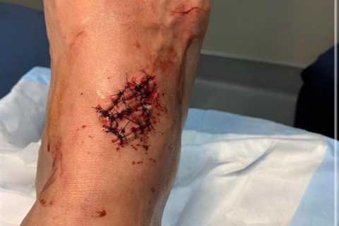 UFC star Eryk Anders shares gruesome gash on foot after horror CHAINSAW accident to leave fans..